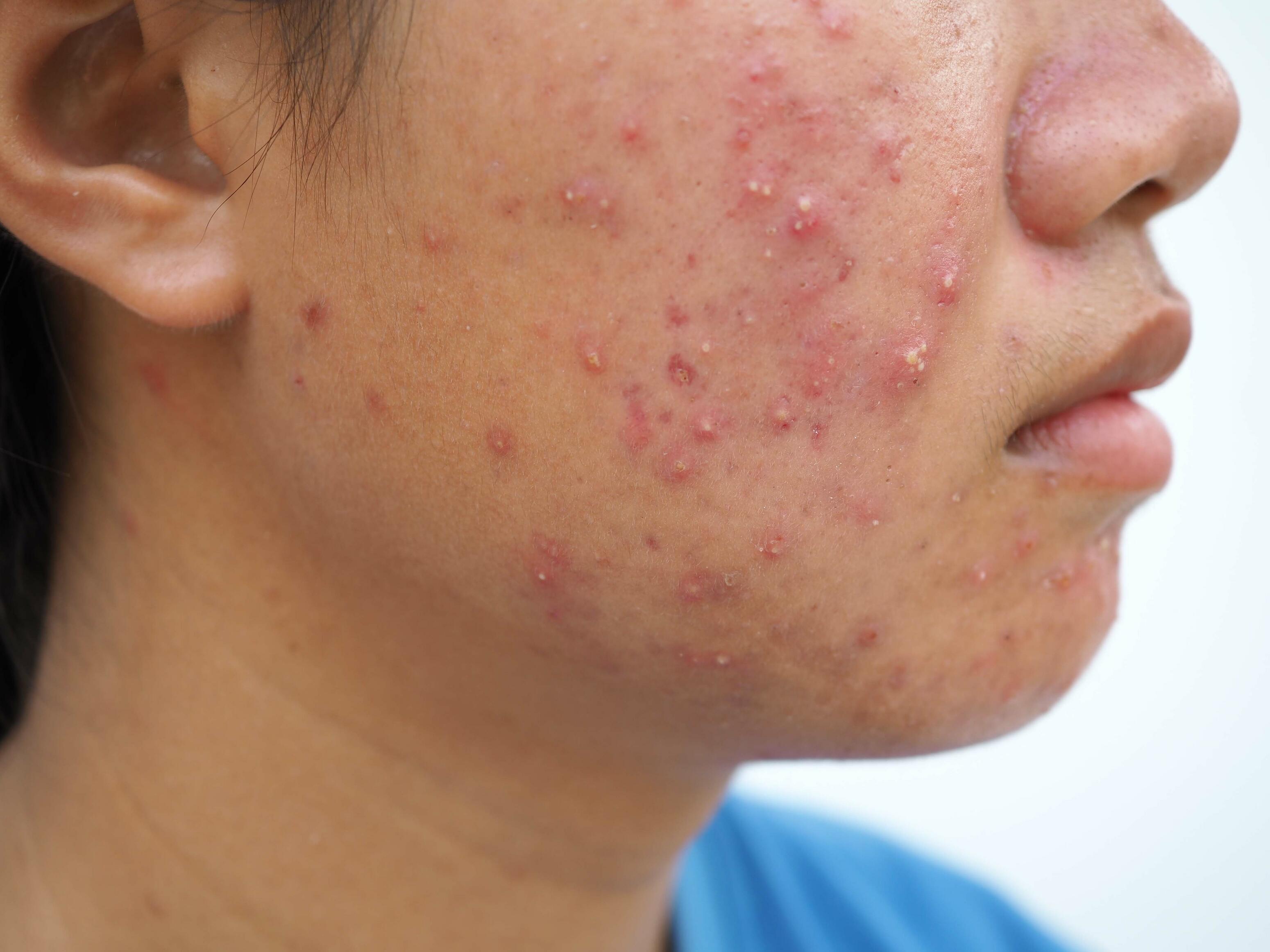 Fungal acne on the side of the face